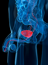 Prostate cancer