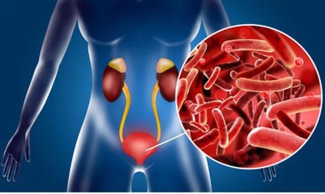 Urinary tract infection (UTI)