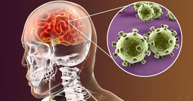 Meningitis
