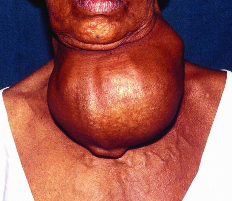 Goiter