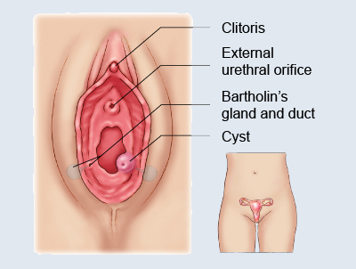 Bartholin’s Cyst