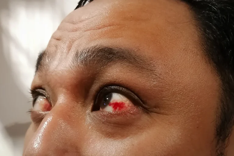 Diabetic retinopathy