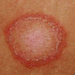 Ringworm (body)